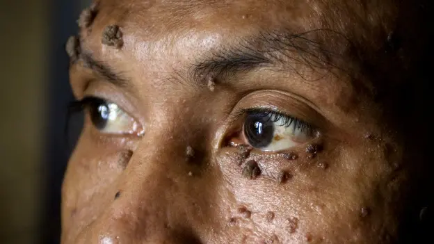 Dede Koswara, el "Hombre árbol"