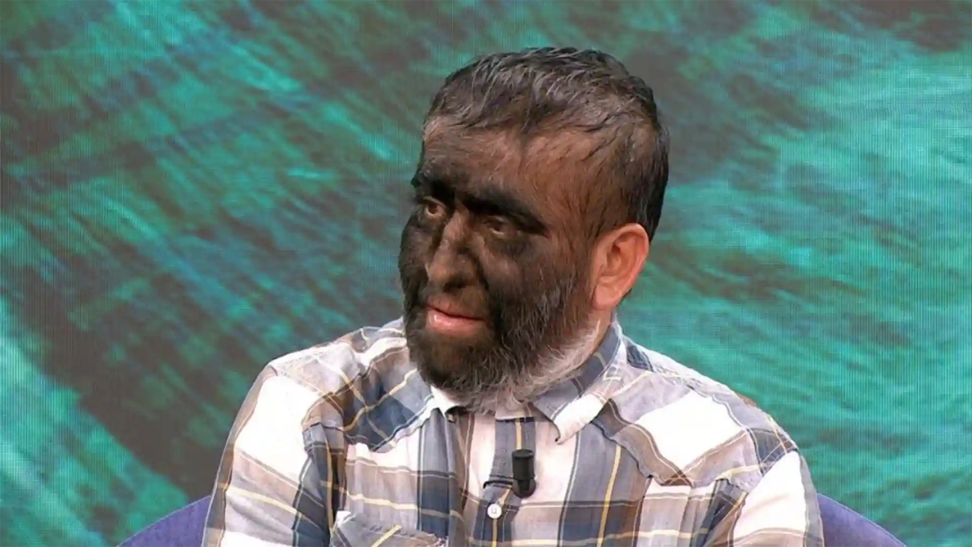 Síndrome del hombre lobo